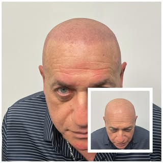 Ka-Pow 💥

Scalp Micropigmentation is a method of tattooing which simulates follicles resulting in a