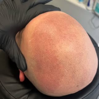 Mid-Swag 

Scalp Micropigmentation is a method of tattooing which simulates follicles resulting in a