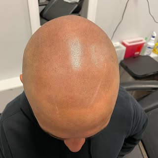 Zoom in for details and see what the scalp king touch is all about! 

Scalp Micropigmentation is a m