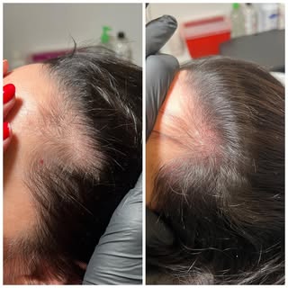 Density fill is a girls best friend. 💪

Scalp Micropigmentation is a method of tattooing which simu