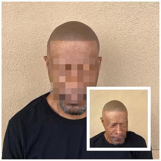3 year touch up! 

Scalp Micropigmentation is a method of tattooing which simulates follicles result