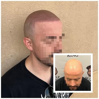 Turning back time ⏰ 

Scalp Micropigmentation is a method of tattooing which simulates follicles res