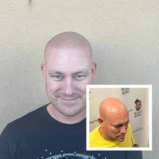 The smile says it all ☑️

Scalp Micropigmentation is a method of tattooing which simulates follicles