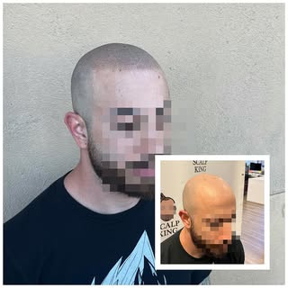 Another one 🎶

Scalp Micropigmentation is a method of tattooing which simulates follicles resulting