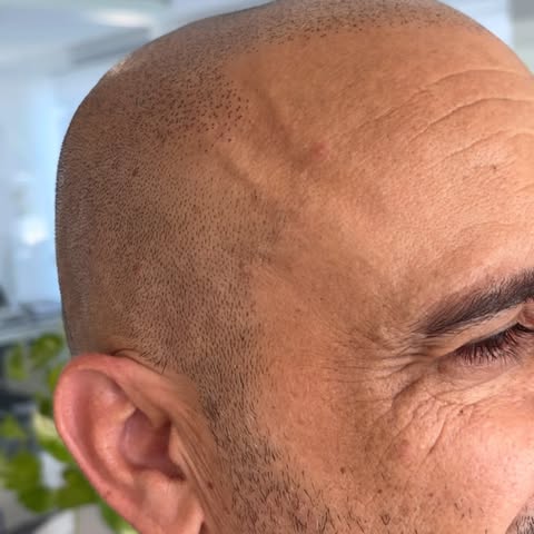 3 seduta *

👑🫆🥳👆🏻🏁 Se desideri una soluzione naturale e duratura per contrastare la calvizie, 