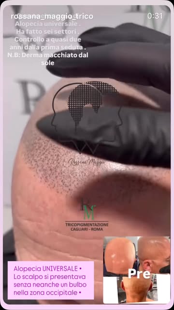 👑🫆🥳👆🏻🏁 Se desideri una soluzione naturale e duratura per contrastare la calvizie, sono a tua d