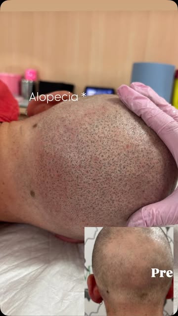 Alopecia *

👑🫆🥳👆🏻🏁 Se desideri una soluzione naturale e duratura per contrastare la calvizie, 