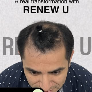 Hair restoration is not about rushing results. ⏳ It’s about precision, patience, and long-term trans