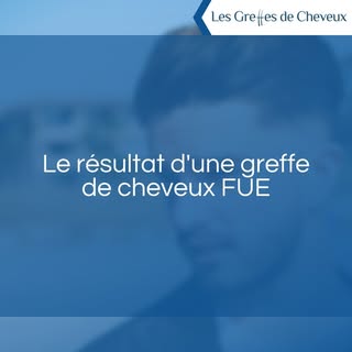 Quels résultats suite à une greffe de cheveux avec la technique FUE?

Vous saurez tout sur les résul