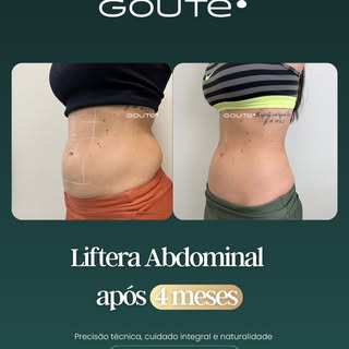 Lembra da Natália, que fez Liftera abdominal e mostramos os primeiros resultados com 30 dias aqui no