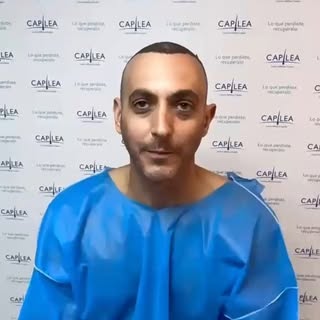Hoy uno de nuestros pacientes nos cuenta cómo fue su experiencia después de la cirugía capilar y cóm