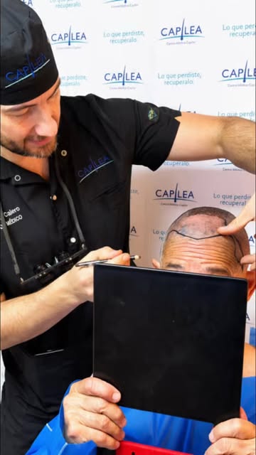Antes de comenzar un implante capilar, cada detalle cuenta.
Medimos.
Diseñamos.
Analizamos las propo