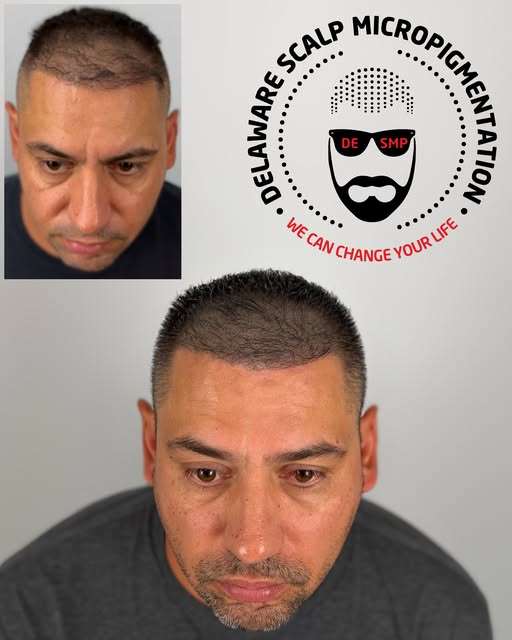 Had a hair transplant but still feel like your hair looks thin on top?

This client actually had two