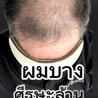 "ไม่ใช่แค่การสัก...แต่คือจุดเริ่มต้นของตัวตนใหม่ที่ดูดีขึ้น"
👴➡️🧑 เรียกความมั่นใจกลับคืนมาอีกครั้ง
