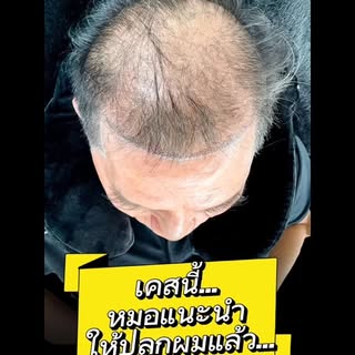 ส่องกระจกทีไร…เห็นหนังศีรษะชัดแบบนี้
หลายคนคิดว่า “ต้องปลูกผมเท่านั้น”
แต่เคสนี้เลือกแก้ด้วย SMP (สั