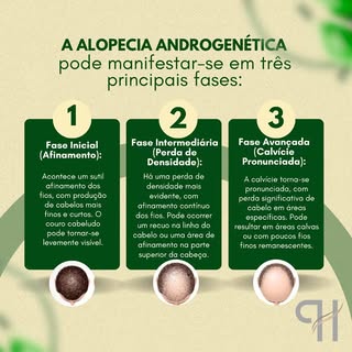 Alopecia Androgenética Masculina — O que é e como tratar?

Conhecida popularmente como calvície masc