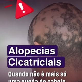 Seu cabelo pode estar sendo destruído... e você nem sabe.
Tem tipos de queda capilar que não avisam 