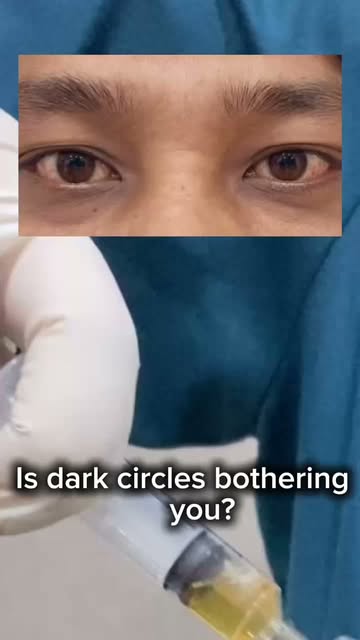Treatment for "Undereye Dark Circle" #darkeye #undereyedarkcircle #darkcircle #darkcircletreatment #