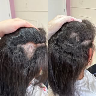 Alopecia areata causada pós trauma por queda! E super comum de acontecer tb em casos em que o emocio