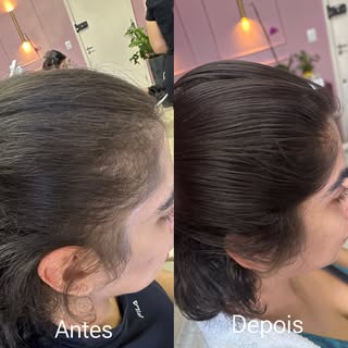 Nada mal para um quadro de alopecia androgenética! Técnicas certas trazem o melhor resultado possíve
