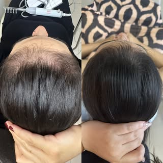 Resultado incrível do tratamento de queda pós parto! Maravilhoso ver uma mamãe poder ter sua autoest