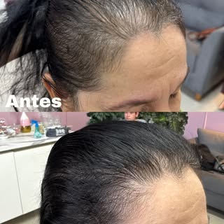 Ficamos felizes em fazer parte da melhora da autoestima das nossas clientes, alopecia androgenética 