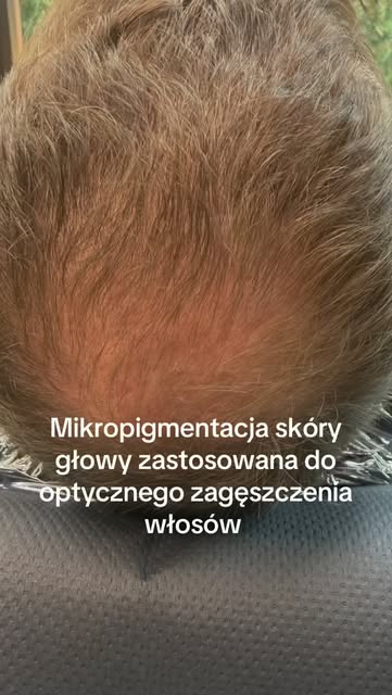 Kiedy czujesz, że fryzura już nie wygląda tak jak kiedyś…
Najtrudniejsze nie jest łysienie. Najtrudn