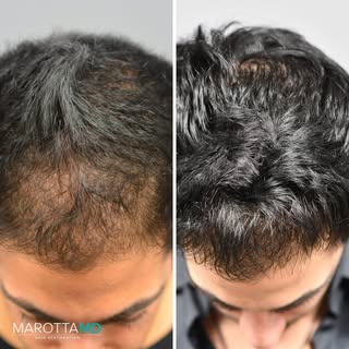 Bring your hair back to life with PRP! 

Our advanced scalp treatment can help restore thinning hair
