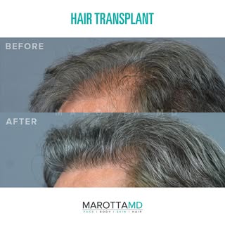 Hair Transformation!🌟 

Remarkable results from a hair transplant procedure performed by Dr. James 
