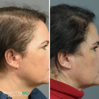 Thicker hair starts here.

PRP scalp therapy at Marotta MD helps revive thinning hair and boost your