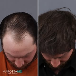 Hair Transformation! ✨

Incredible results from a hair transplant by @drjamesmarotta  paired with PR