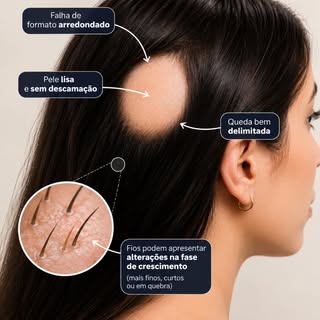 Alopecia areata é uma condição autoimune que pode causar queda de cabelo em áreas bem delimitadas, g