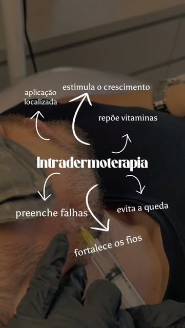A intradermoterapia capilar é um procedimento realizado com aplicação localizada de ativos no couro 
