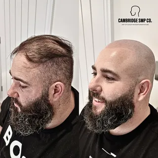 Say goodbye to your hair worries and hello to a fresh new look! 😎

My client suffers with male patt