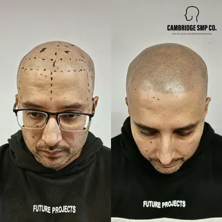 Our client had Scalp Micropigmentation from another company four years ago, it started fading and in