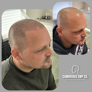 My client wanted a hairline that felt soft yet defined, with gentle shape and added fullness to rest