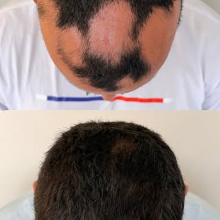 O tratamento da alopecia areata pode recuperar o cabelo de uma maneira surpreendente!
Vamos juntos c