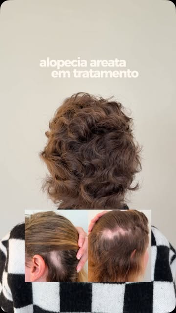 Esta paciente estava com múltiplas falhas de alopecia areata e queda capilar intensa no início do tr