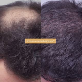 👉🏻Is your crown bothering you? 

👉🏻We can help.

👉🏻Here’s a case study where we completed a cr