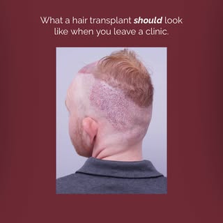 What good hair transplant surgery actually looks like 👆🏼

Scroll your feed long enough and you’ll 