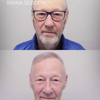 Brian started losing his hair at 30. He did something about it at 70.

For most of those forty years