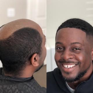NOW OFFERING: Non surgical Hair Replacement🔥

Are you suffering from hair loss, unable to regrow yo