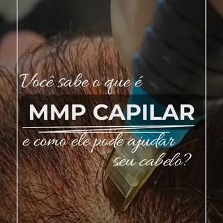 O MMP capilar é indicado para casos de queda persistente, afinamento dos fios e início de rarefação 