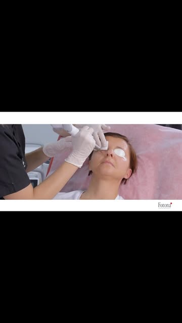 SmoothEye mit Fotona – gezielte Behandlung für die empfindliche Augenregion

Müder Blick, feine Lini