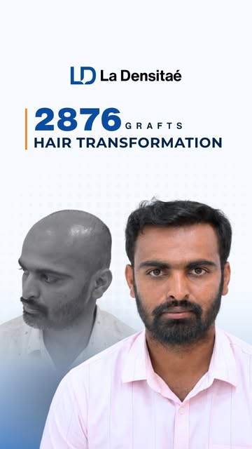 The comb test never lies. 

There’s a point where you get tired of hiding your hairline and just wan
