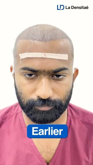 Hair Transplantation 🫣