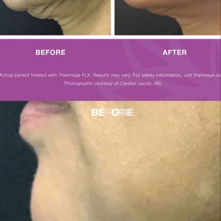 Tighter, smoother skin — no surgery, no downtime. 🔥 Thermage® uses radiofrequency to heat the deep 