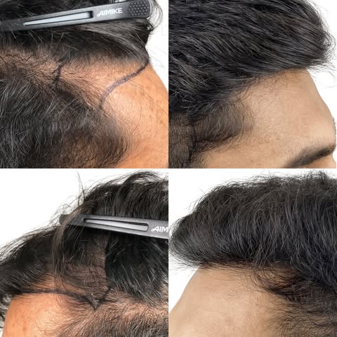 At Houston Hair, we believe quality should always come before price. A hair transplant isn't just an
