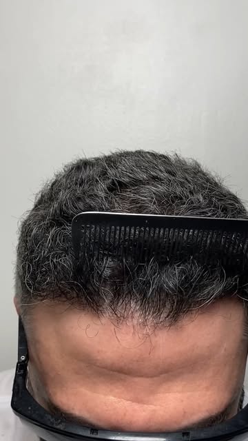 One of the best ways to judge the true quality of a hair transplant is to comb through the hair. Hai
