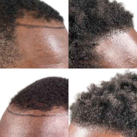 This 30-year-old African American male underwent an FUE hair transplant, and at 12 months, the trans